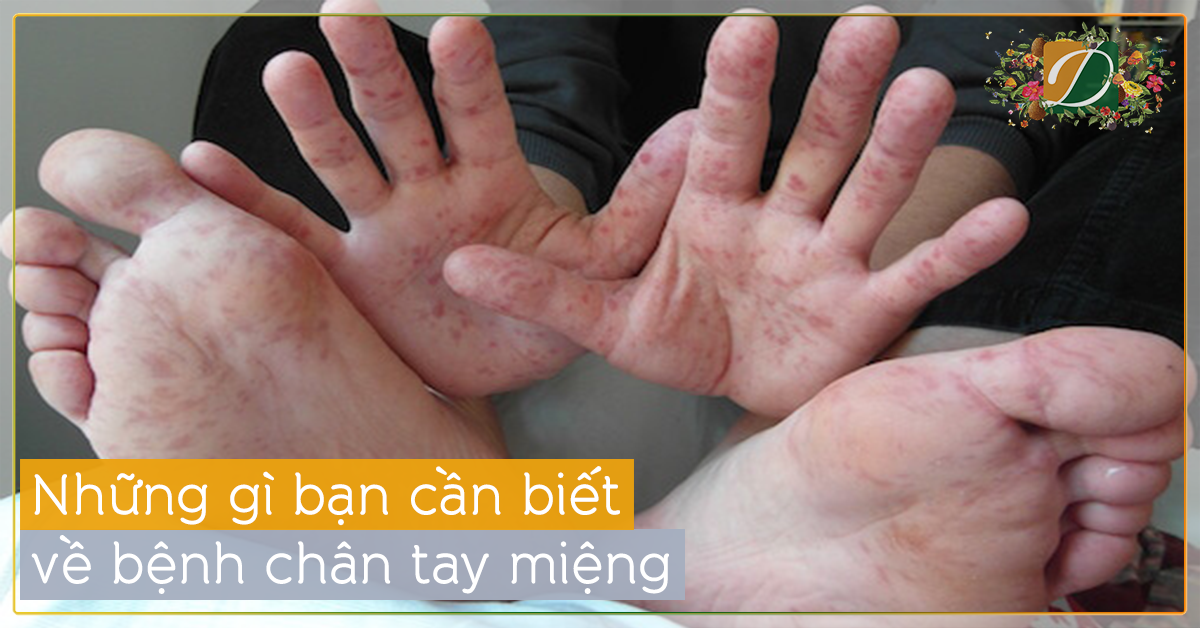 BỆNH CHÂN TAY MIỆNG VÀ CÁCH PHÒNG NGỪA